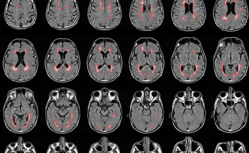Mehrere Reihen von MRT-Schnittbildern des Gehirns in axialer Ansicht. Auf den Bildern sind bestimmte Bereiche rot markiert. Links oben befindet sich eine schematische Darstellung des Gehirns mit eingezeichneten Ebenen. Die Spalten sind mit &bdquo;Rechts&ldquo; und &bdquo;L