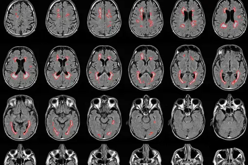 Mehrere Reihen von MRT-Schnittbildern des Gehirns in axialer Ansicht. Auf den Bildern sind bestimmte Bereiche rot markiert. Links oben befindet sich eine schematische Darstellung des Gehirns mit eingezeichneten Ebenen. Die Spalten sind mit &bdquo;Rechts&ldquo; und &bdquo;L
