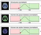 Drei nebeneinander aufgebaute Auswertungen der Hirnvolumetrie. Links jeweils ein farbig markiertes MRT-Schnittbild. Rechts daneben Kurvendiagramme mit farbigen Bereichen und einem markierten Punkt, der die normalisierten Werte f&uuml;r das gesamte Hirnvolumen,