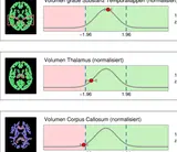 Grafische Darstellung dreier Auswertungen der Hirnvolumetrie. Links jeweils ein MRT-Schnittbild mit farblich markierten Hirnregionen. Rechts daneben Kurvendiagramme mit farbigen Bereichen und einem Punkt, der die normalisierten Volumenwerte f&uuml;r den Tempor
