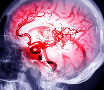 Profilansicht eines menschlichen Schädels als Röntgenbild, bei dem das zerebrale Gefäßsystem durch eine leuchtend rote Einfärbung der Arterien und Venen kontrastreich hervorgehoben wird.