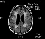 Schwarz-Weiß-Aufnahme eines Gehirn-Scans von oben. Die Aufnahme zeigt die Gehirnstruktur mit symmetrischen dunklen Hohlräumen in der Mitte und hellen Flecken im umliegenden Gewebe.